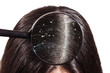 The doctor looks through a magnifying glass at the dandruff on dark female hair