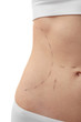 © Africa Studio - Female tummy on white background. Plastic surgery concept