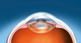 Fototapeta  - Human eye with artifical lens, medical illustration