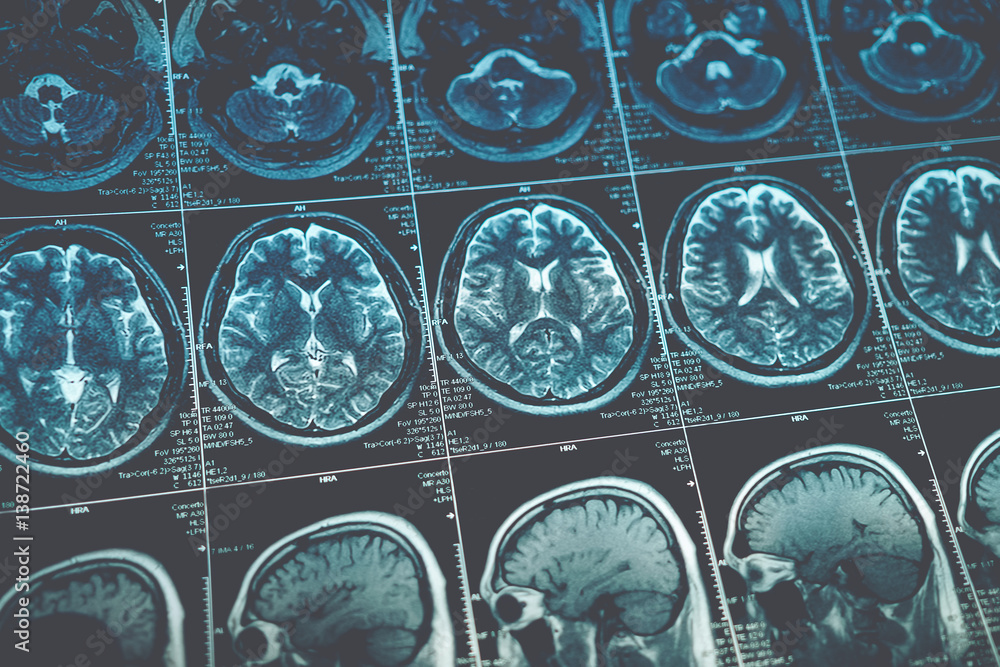 MRI or magnetic resonance image of head and brain scan. Close up view ...