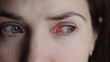 Closeup of irritated or infected red bloodshot eyes - conjunctivitis