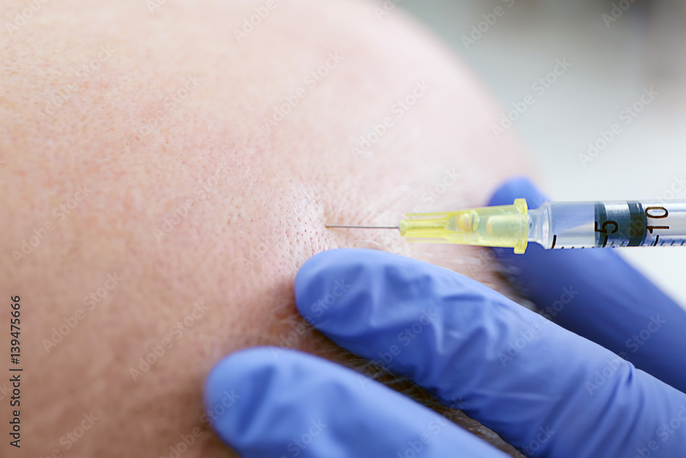 Senior man with hair loss problem receiving injection in clinic, closeup