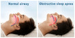 © Africa Studio - Snore problem concept. Illustration of normal airway and obstructive sleep apnea