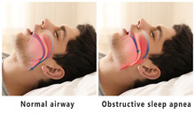 Snore Problem Concept. Illustration Of Normal Airway And Obstructive Sleep Apnea