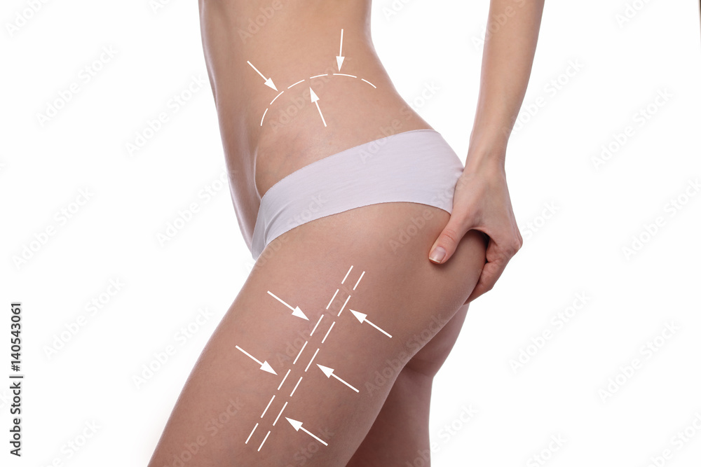 Female body with the arrows drawing on it. Fat lose, liposuction and cellulite removal concept. Sport, fitness, Dieting results. - obrazy, fototapety, plakaty 