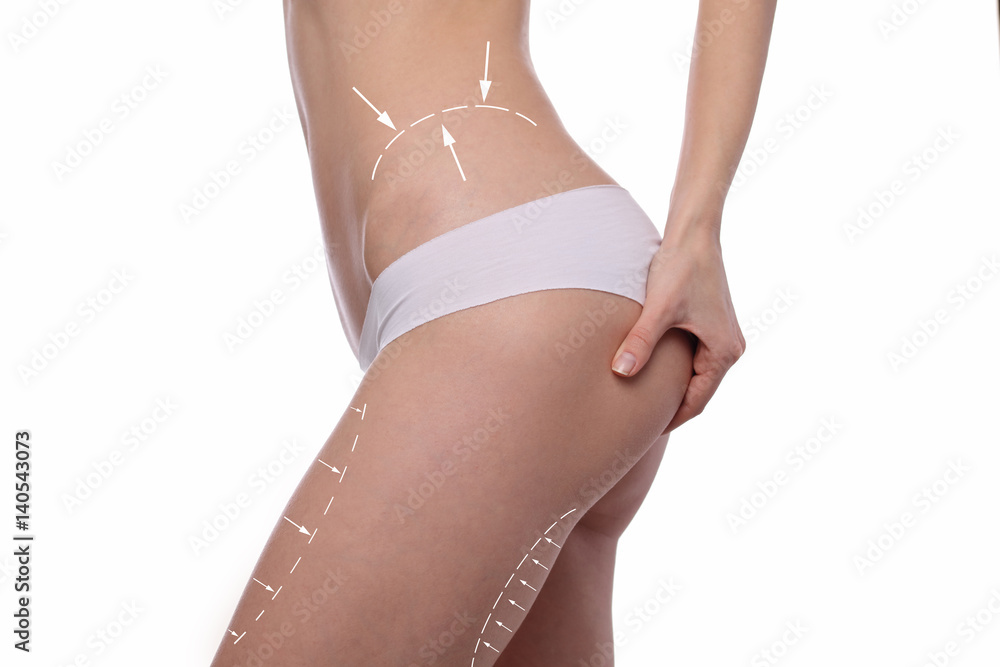 Female body with the arrows drawing on it. Fat lose, liposuction and cellulite removal concept. Sport, fitness, Dieting results. - obrazy, fototapety, plakaty 