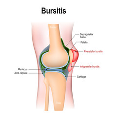 Poster - Bursitis is the inflammation of bursae