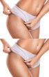© blackday - Hips after stretch mark removal treatment