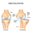 Knee dislocation and normal.