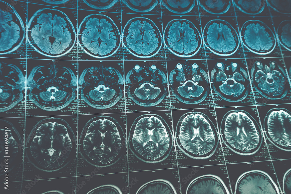 MRI or magnetic resonance image of head and brain scan, toned image ...