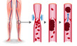 Economy class syndrome mechanism, deep vein thrombosis(DVT), Pulmonary Embolism(PE), coronary thrombosis, illustration diagram