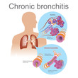 Chronic bronchitis. Acute bronchitis is usually caused by viruses, typically the same viruses that cause colds and flu.