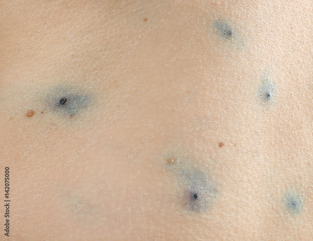 Skin of human ill with chicken pox, closeup