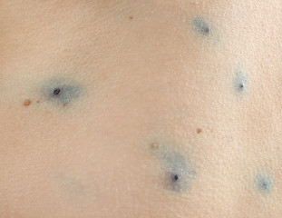 Wall Mural - Skin of human ill with chicken pox, closeup