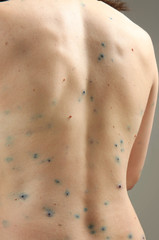 Wall Mural - Back of woman ill with chicken pox, closeup