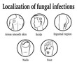 © scio21 - The localization of fungal infections