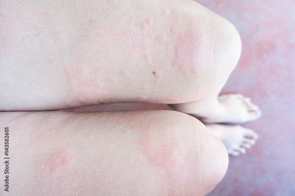 Rash from allergic infection, eczema dermatitis Stock Photo | Adobe Stock