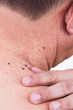 © ThamKC - Finger embrace mole on neck and shoulder of Asian male