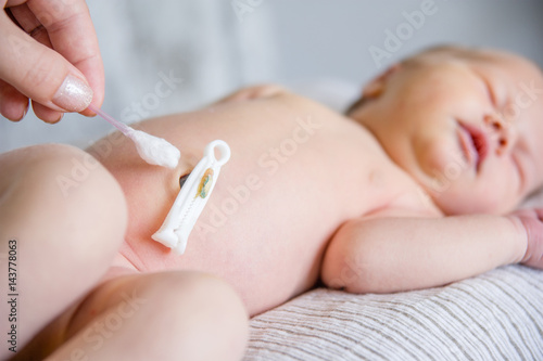 Fotomural Treatment of newborn baby navel with a cotton swab