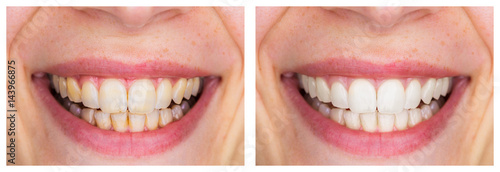 Fotografía Whitening - Dental care, a beautiful smile and teeth whitening treatment before and after