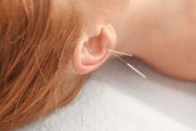 Therapy Of Female Ear With Pricking Acupuncture Needles