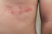 Detail Of Body Skin With Herpes Zoster (Shingles)