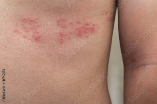 herpes collegamento sito metropolitana di carta annunci di incontri