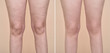 Legs of a woman before and after anti cellulite treatment