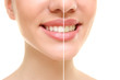 © Africa Studio - Result of teeth whitening. Smiling young woman on white background, closeup