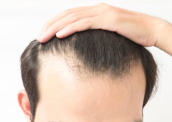 Young man serious hair loss problem for health care shampoo and beauty product concept