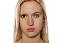 Young Blonde With Pimples On Her Forehead