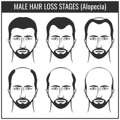 Hair loss stages and types of baldness. Man hairs problem vector charts