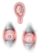 © Judith - Cervical cerclage, a surgery used to keep an incompetent cervix closed during pregnancy.