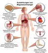 Auswirkungen von Magnesiummangel, Hypomagnesiämie