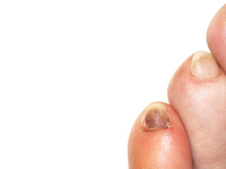 Toes after injury, isolate on white background. Bruise under the nail of the little finger.