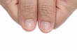 White spots and Vertical ridges on the fingernails symptoms deficiency vitamins 