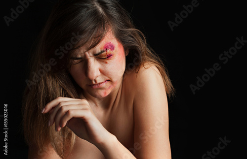 Beaten Young Woman With Bruises On Her Face Abuse Violence Concept Beaten Young Woman With Bruises On Her Face Abuse Violence Concept
