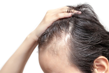 Bald man or woman worry about his or her less hairline on white background isolated