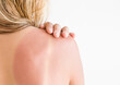Woman's back skin hurt from sun burn.