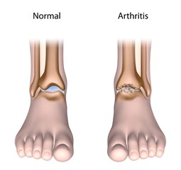 Arthritis of the ankle joint