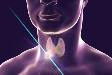 Sticker - Destruction of thyroid nodule by laser, 3D illustration. Conceptual image for thyroid tumor treatment