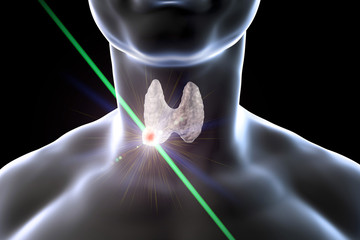 Poster - Destruction of thyroid nodule by laser, 3D illustration. Conceptual image for thyroid tumor treatment