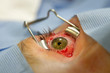 © RF BSIP - STRABISMUS, SURGERY