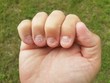 bitten fingernails