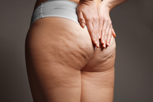 Woman With Cellulite Problem On Dark Background