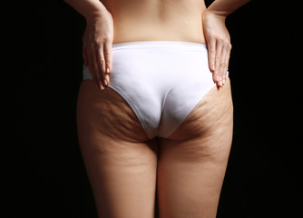 Sticker - Woman with cellulite problem on black background