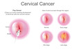 © PATTARAWIT - Stage of Cervical cancer. Education info graphic vector.