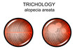 alopecia areata. trichology