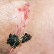 © gubernat - Scar and scab (eschar) on the leg.