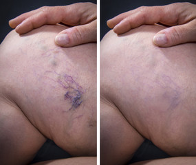 Human leg with varicose veins before and after treatment